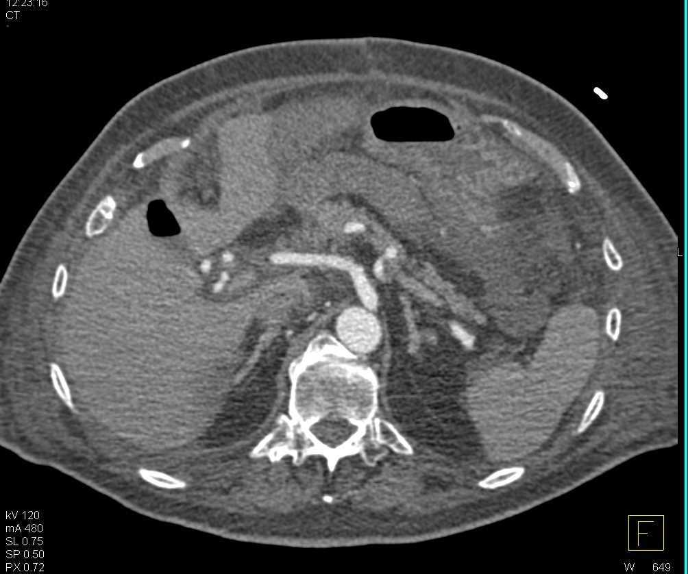 Gastroduodenal Artery (GDA) Pseudoaneurysm S/P Whipple - CTisus CT Scan