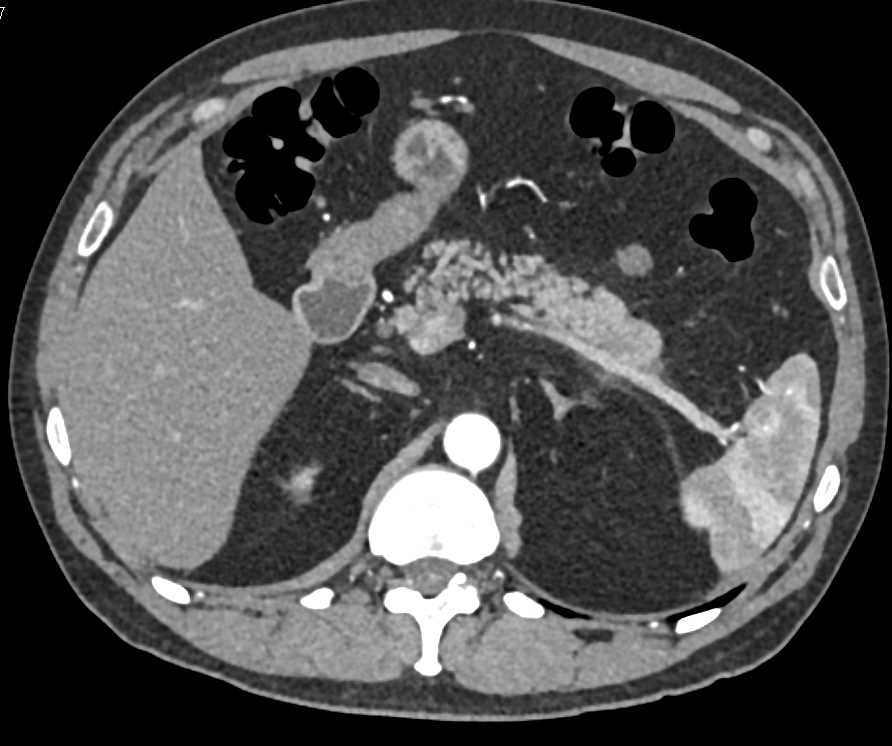 Subtle Carcinoma Tail of the Pancreas - CTisus CT Scan