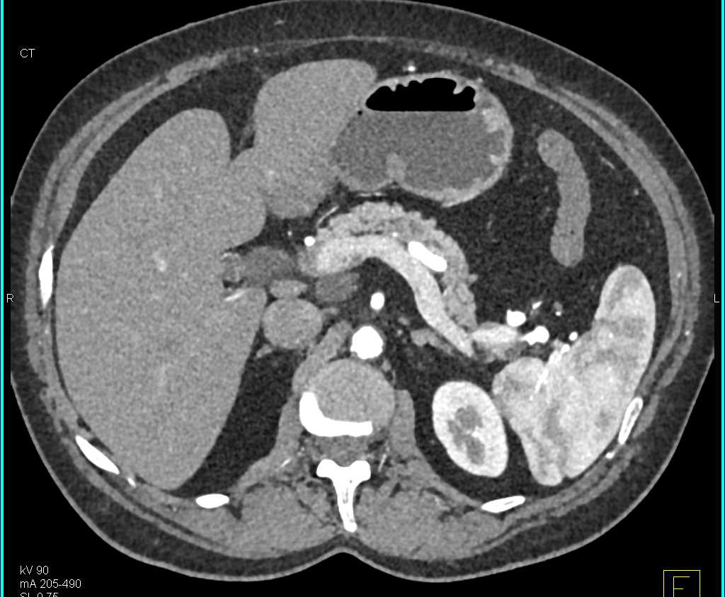 Serous Cystadenoma Pancreas - CTisus CT Scan