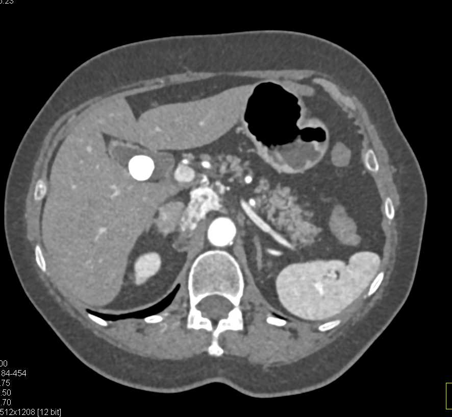 Neuroendocrine Tumor Near Pancreas - CTisus CT Scan