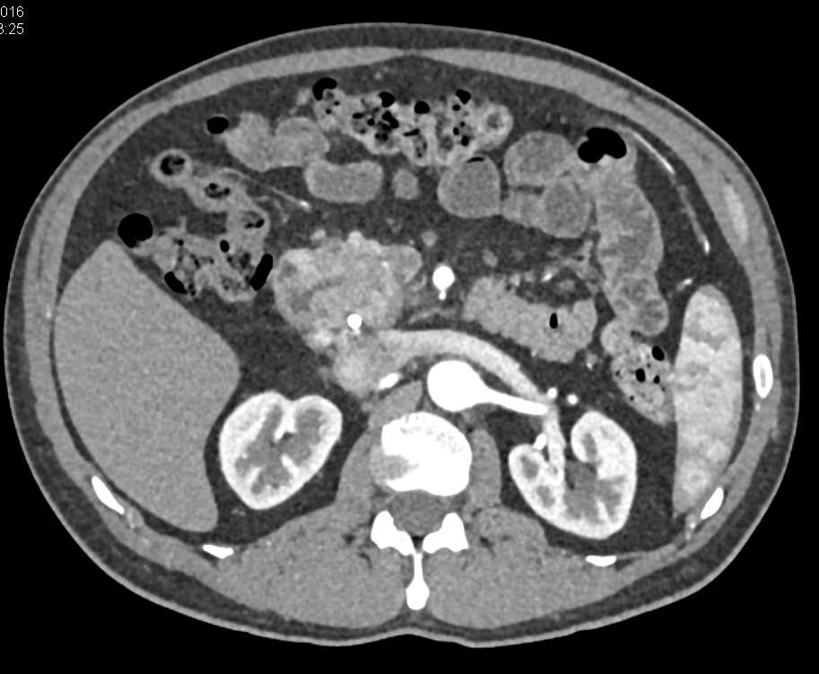 Pancreatic Adenocarcinoma - CTisus CT Scan