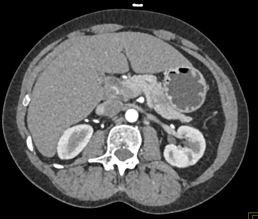 Subtle Pancreatic Carcinoma at Junction of Tail and Body of Pancreas - CTisus CT Scan