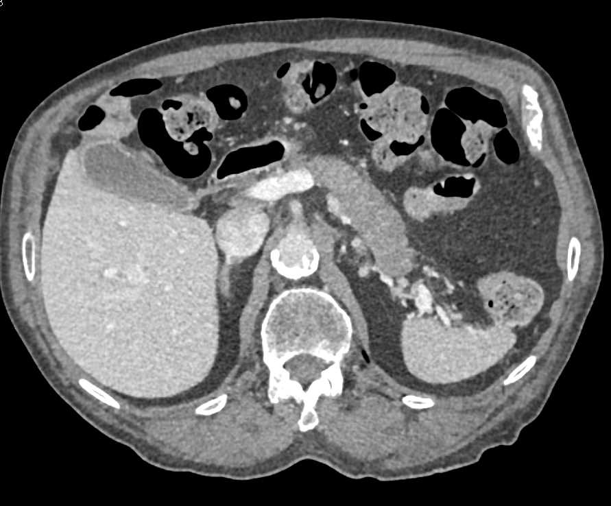 Autoimmune Pancreatitis Presents as a Mass - CTisus CT Scan