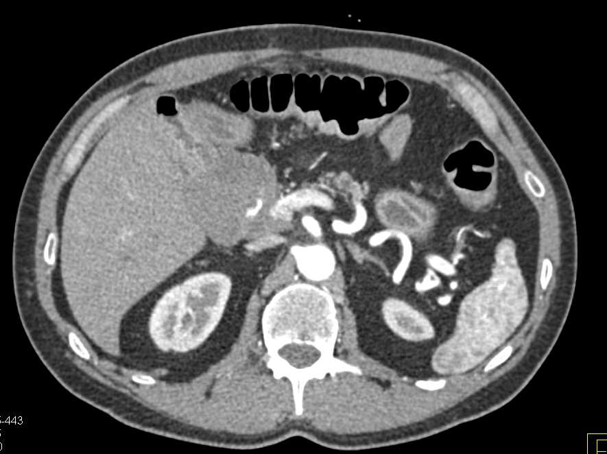 Pancreatic Adenocarcinoma Involves Vessels and the Head of Pancreas - CTisus CT Scan