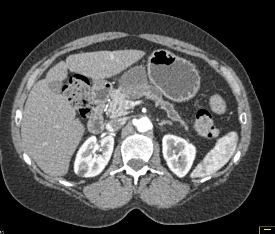 Adenocarcinoma Pancreas Obstructs the Pancreatic Duct - CTisus CT Scan