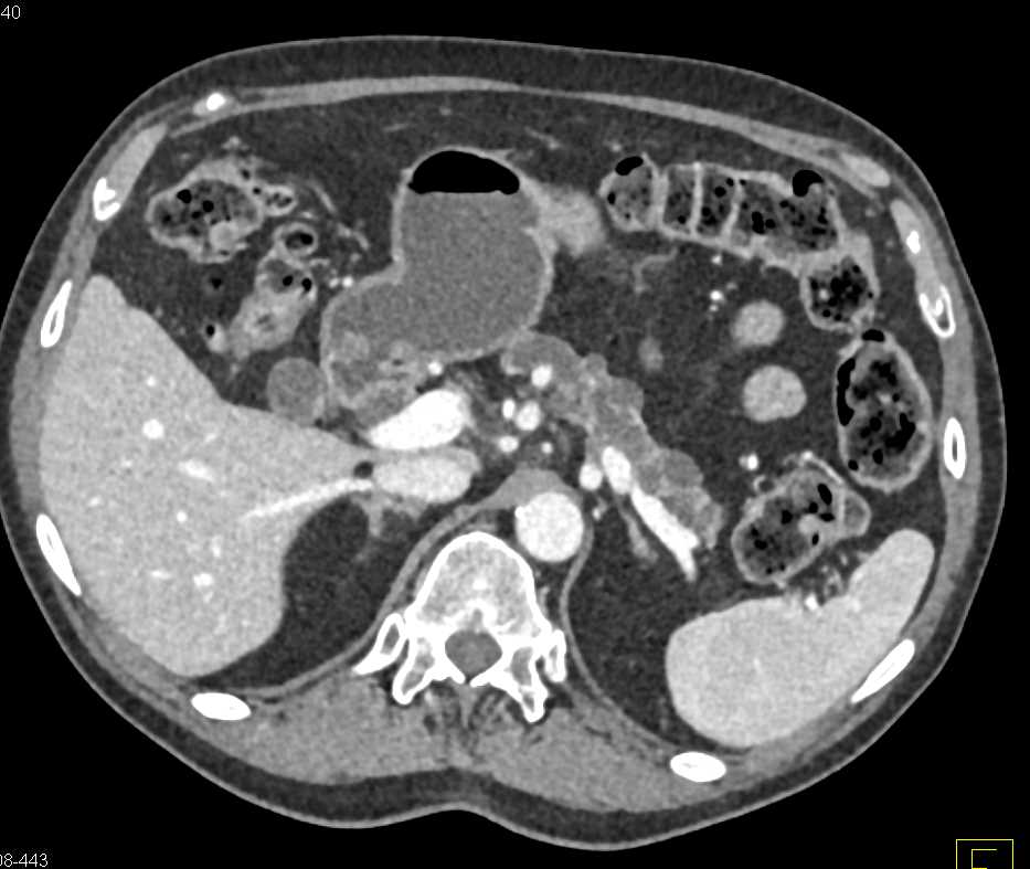 Pancreatic Adenocarcinoma Invades the Portal Vein - CTisus CT Scan