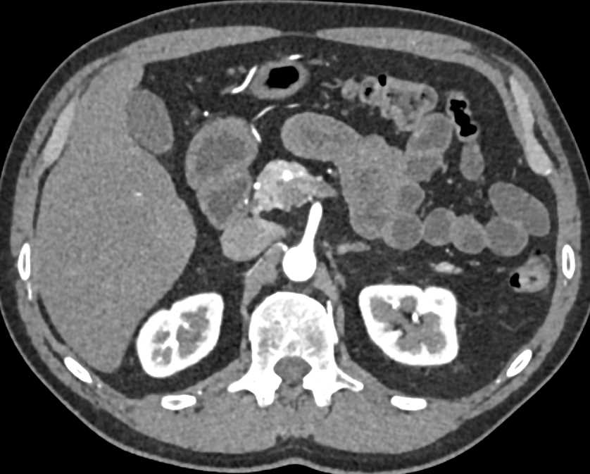 1cm Pancreatic Neuroendocrine Tumor (PNET) in the Head of the Pancreas - CTisus CT Scan