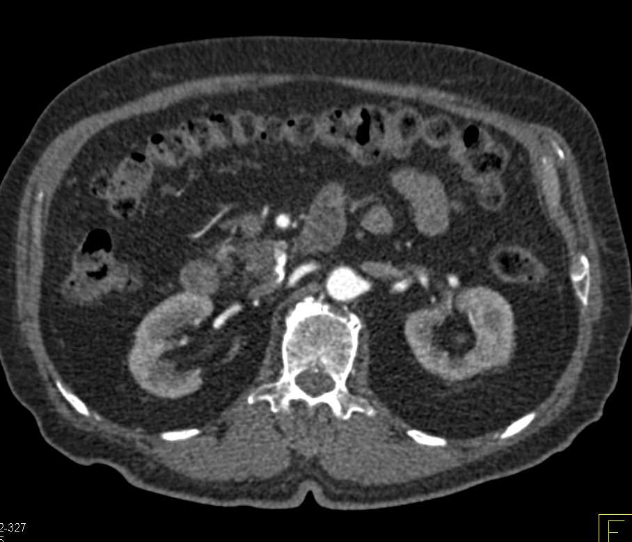 Intraductal Papillary Mucinous Neoplasm (IPMN) in the Head of Pancreas - CTisus CT Scan