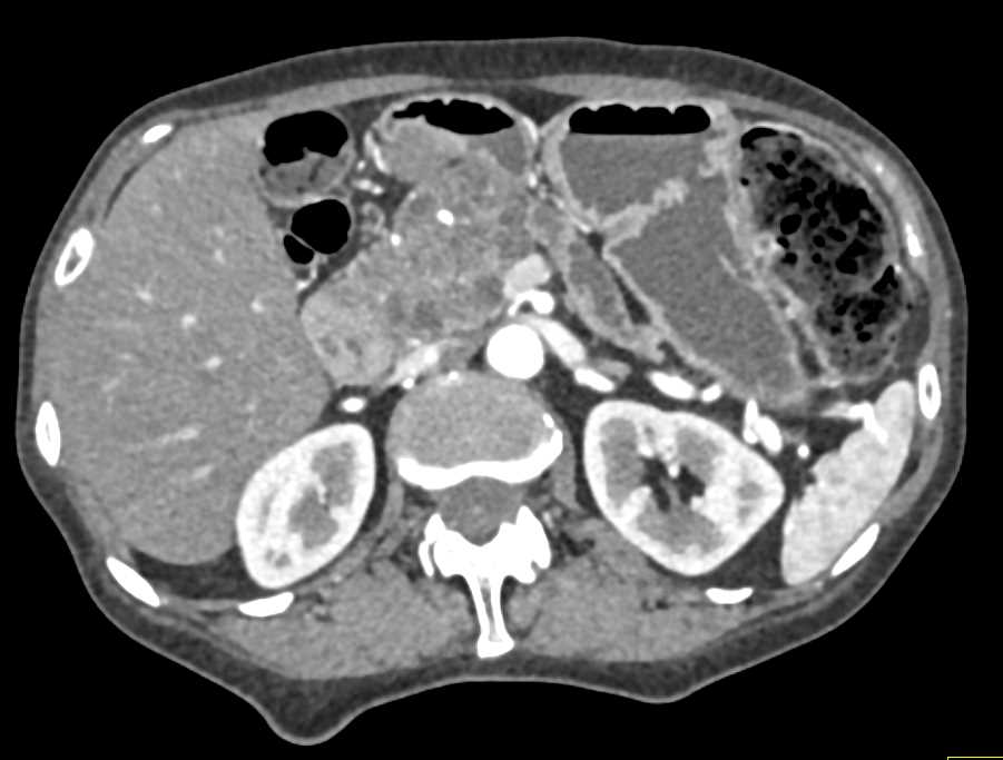 Serous Cystadenoma Pancreas Obstructs the Pancreatic Duct - CTisus CT Scan