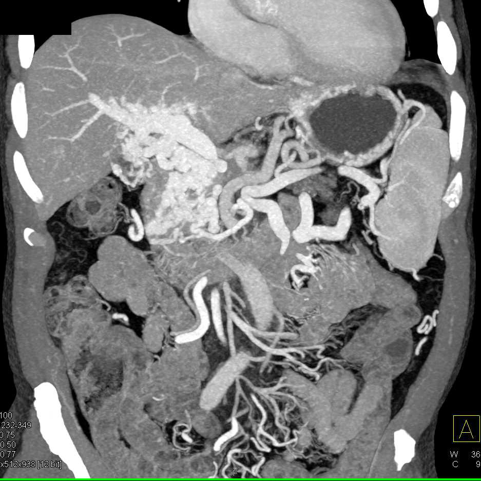 Pancreatic Adenocarcinoma with Cavernous Transformation of the Portal Vein (CTPV) and Dilated Pancreatic Duct - CTisus CT Scan