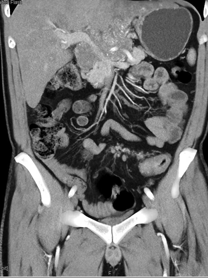 Neuroendocrine Tumor with Liver Metastases - CTisus CT Scan