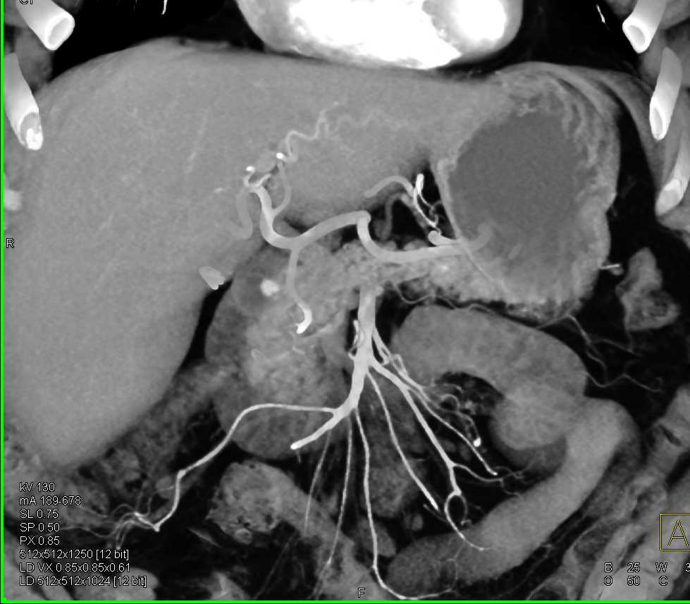 Subtle Carcinoma Head of the Pancreas - CTisus CT Scan