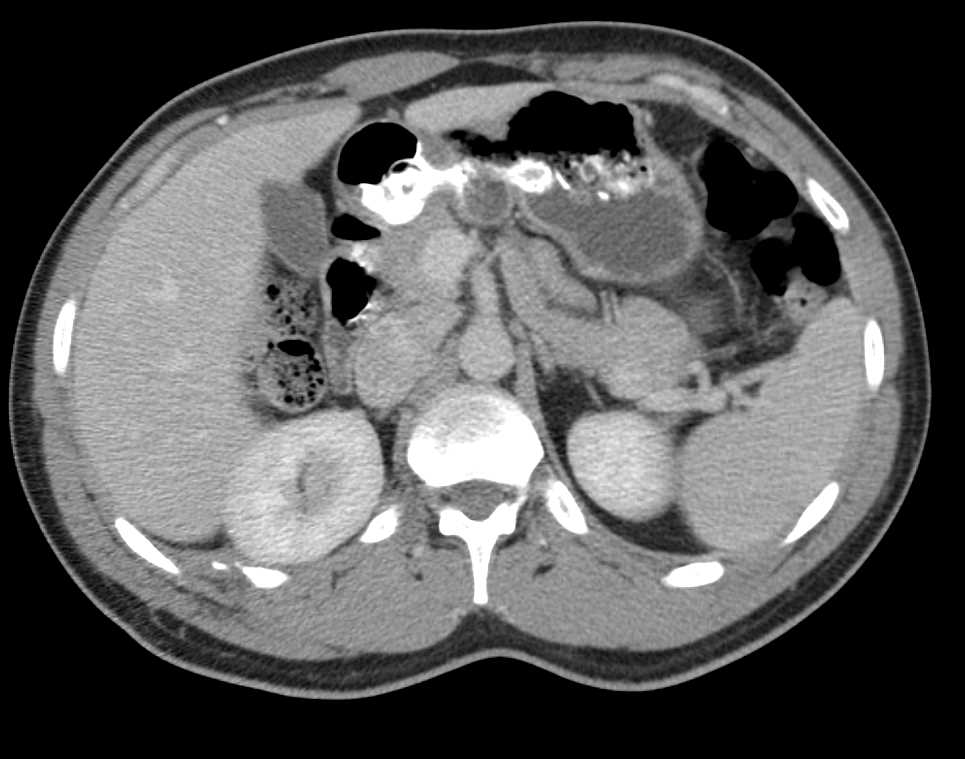 Cystic Neuroendocrine Tumor Tail of the Pancreas Was to its on Initial Images - CTisus CT Scan