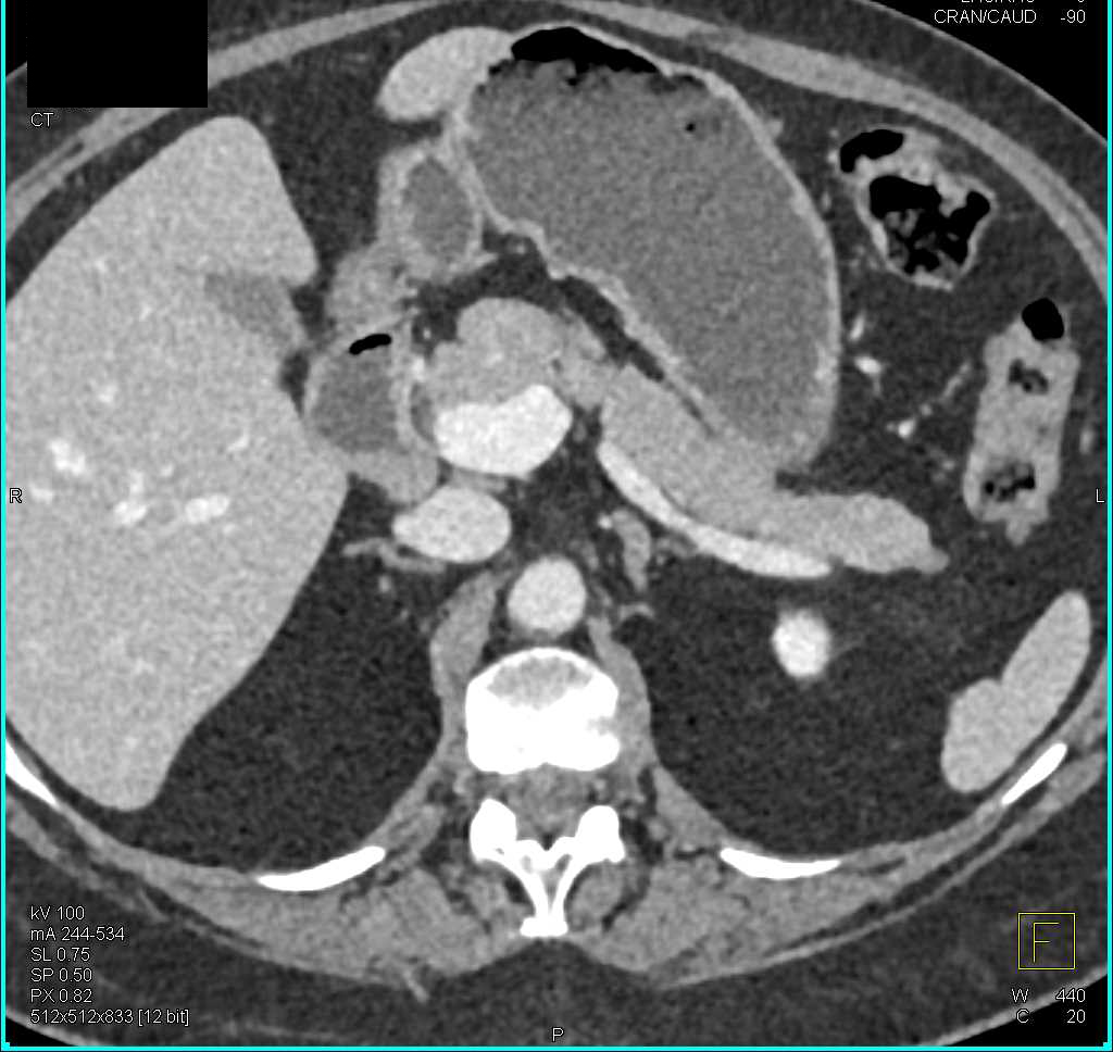 1cm Pancreatic Neuroendocrine Tumor (PNET) Tail of Pancreas - CTisus CT Scan