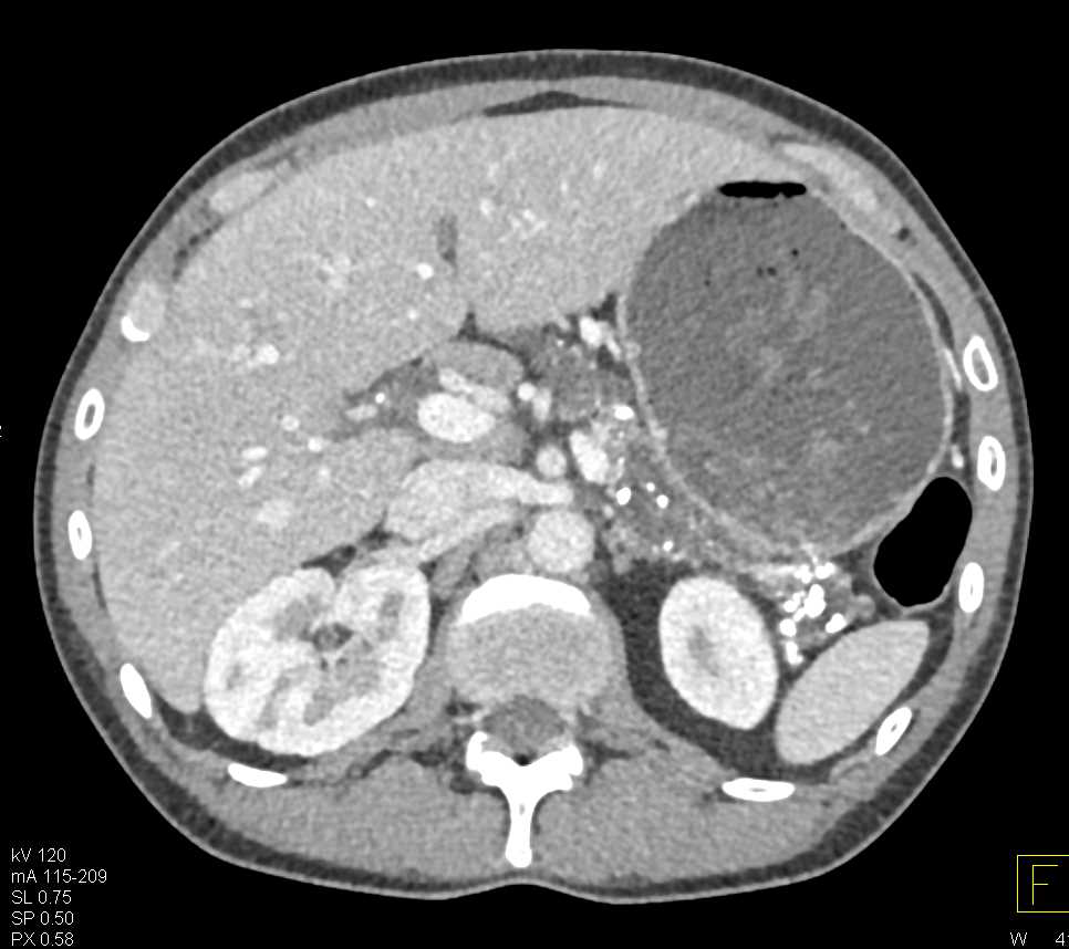 Chronic Pancreatitis with Calcifications - CTisus CT Scan