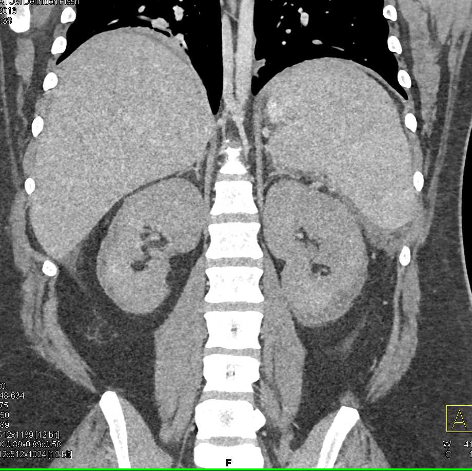 Pancreatic Necrosis - CTisus CT Scan