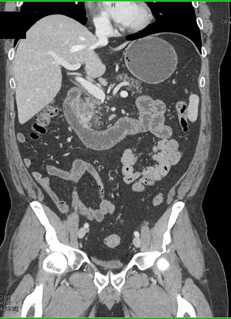 Adenocarcinoma of the Head of the Pancreas - CTisus CT Scan