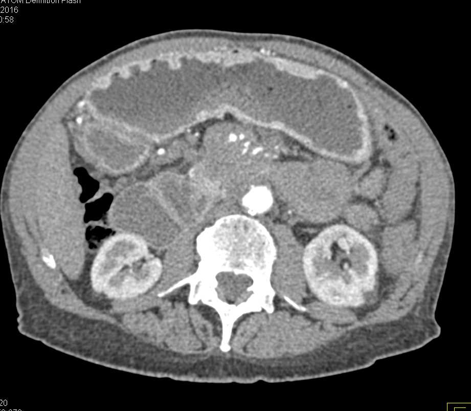 Adenocarcinoma Body of Pancreas with Vascular Invasion - CTisus CT Scan