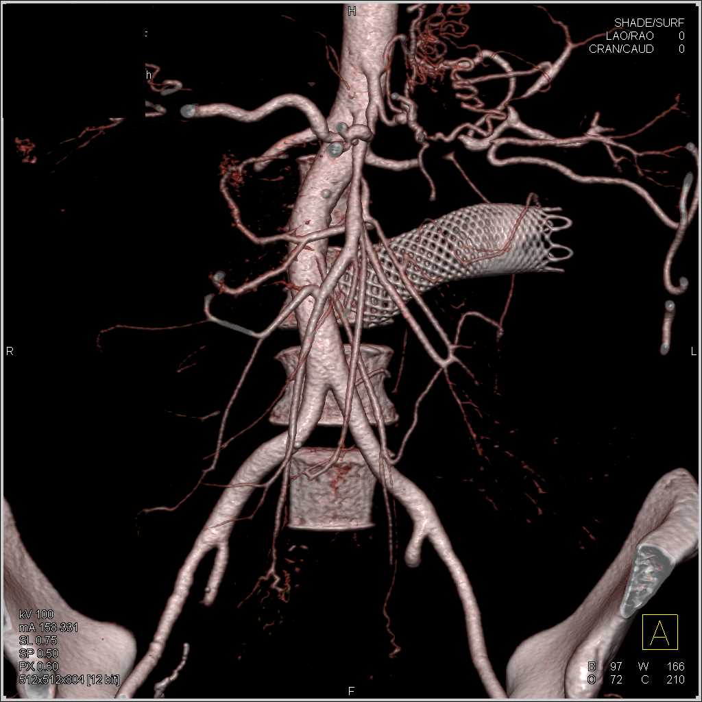 Pancreatic Adenocarcinoma with Carcinomatosis and Vascular Encasement - CTisus CT Scan