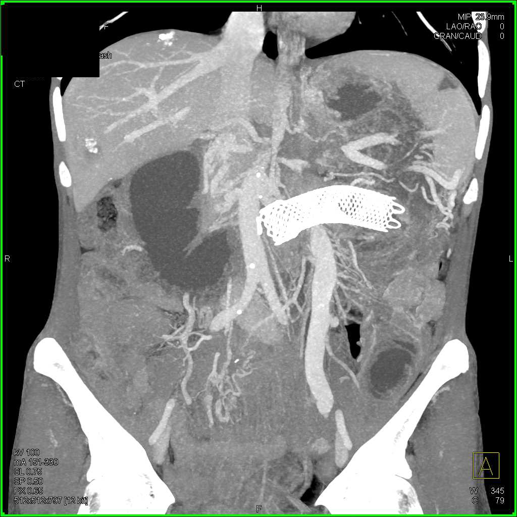 Pancreatic Adenocarcinoma with Carcinomatosis and Vascular Encasement - CTisus CT Scan