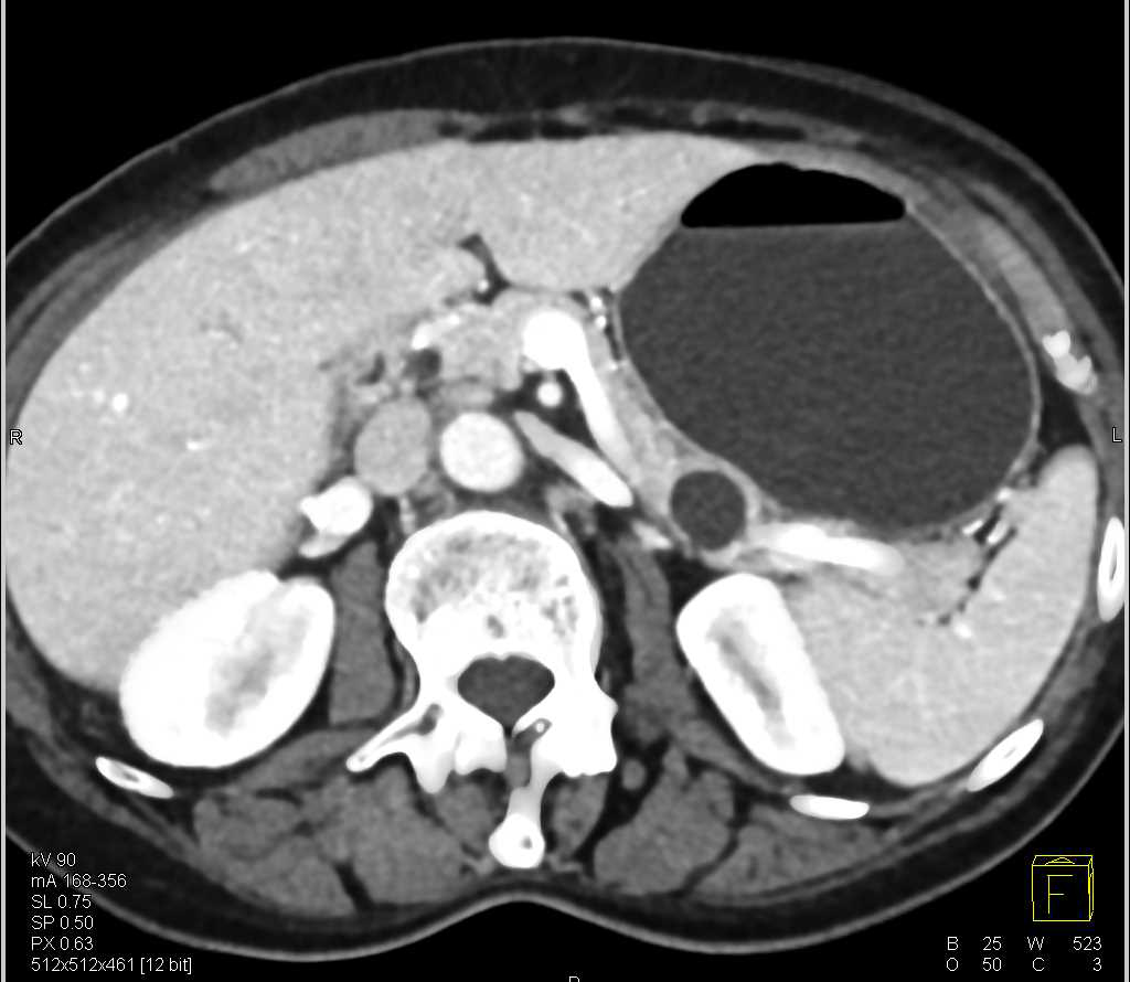 Intraductal Papillary Mucinous Neoplasm (IPMN) - CTisus CT Scan