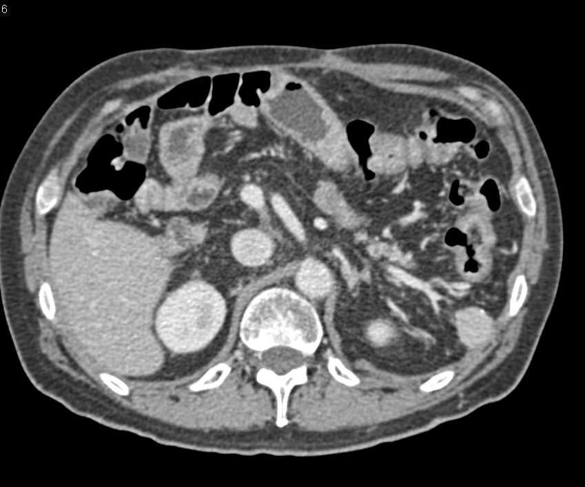 Post-Whipples Changes - CTisus CT Scan