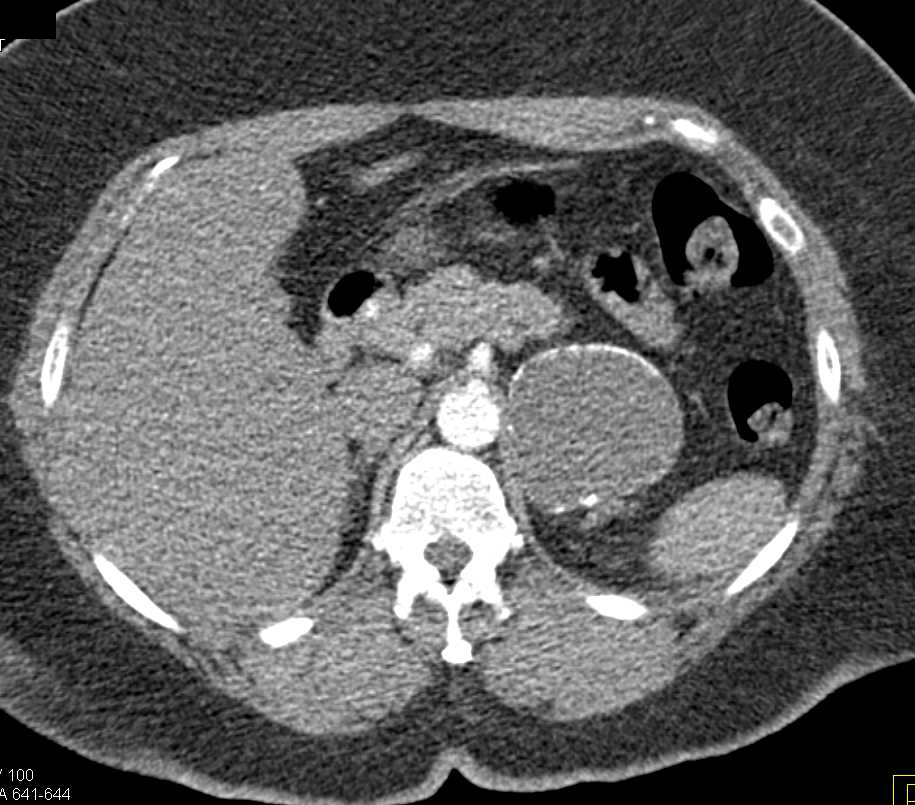 Adrenal Cyst - CTisus CT Scan