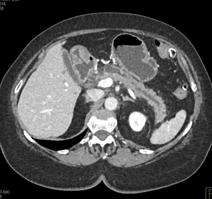 Pancreas Adenocarcinoma with Dilated Pancreatic Duct - CTisus CT Scan