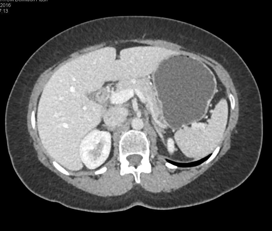 Subtle Tumor Head of Pancreas with Dilated Pancreatic Duct - CTisus CT Scan