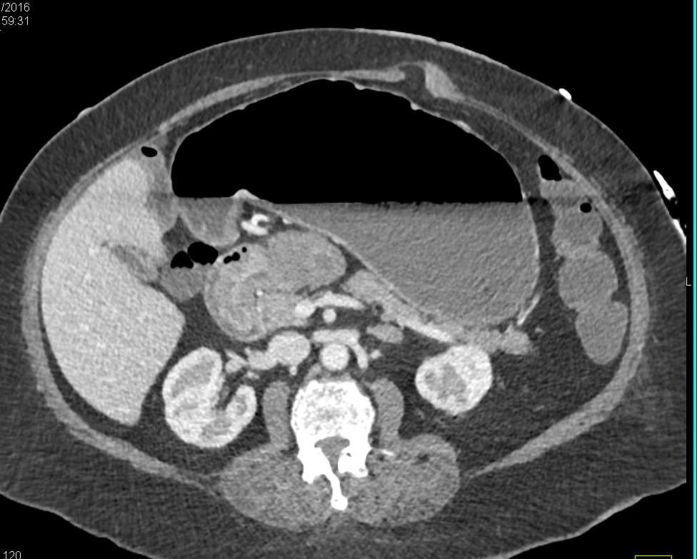 Ampullary Carcinoma - CTisus CT Scan