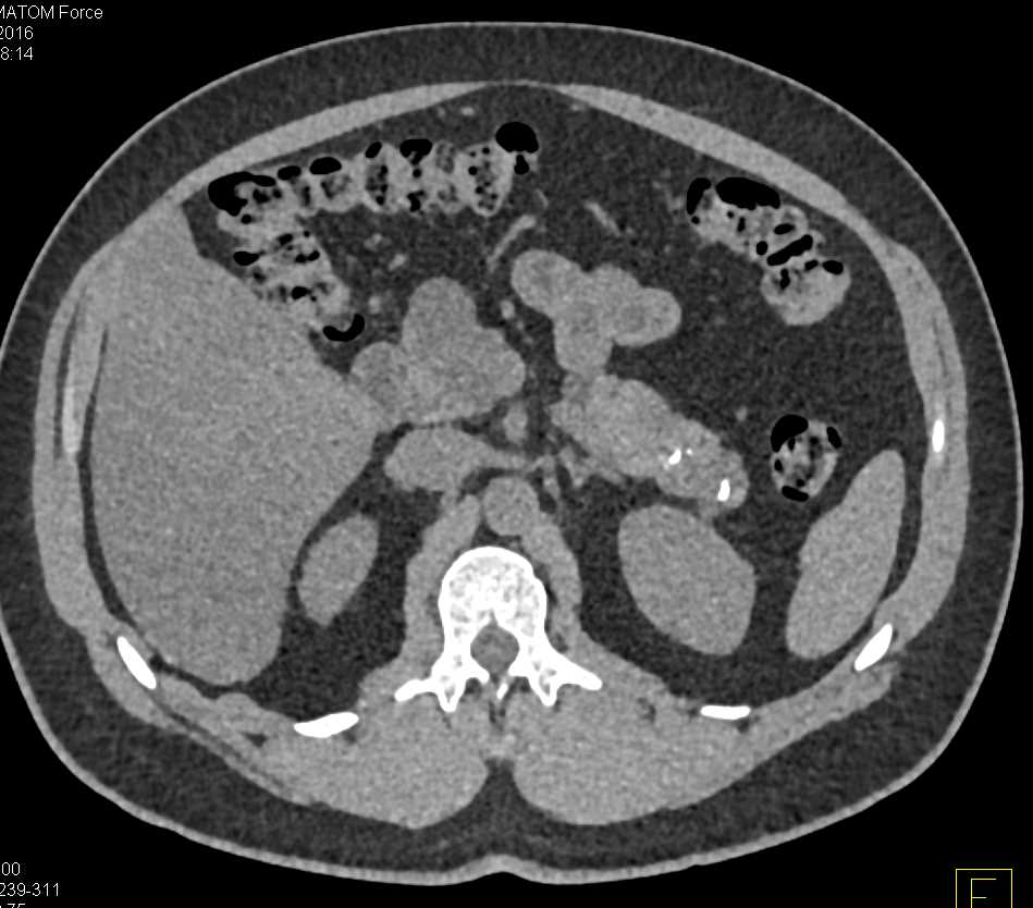 Chronic Pancreatitis with Calcifications - CTisus CT Scan