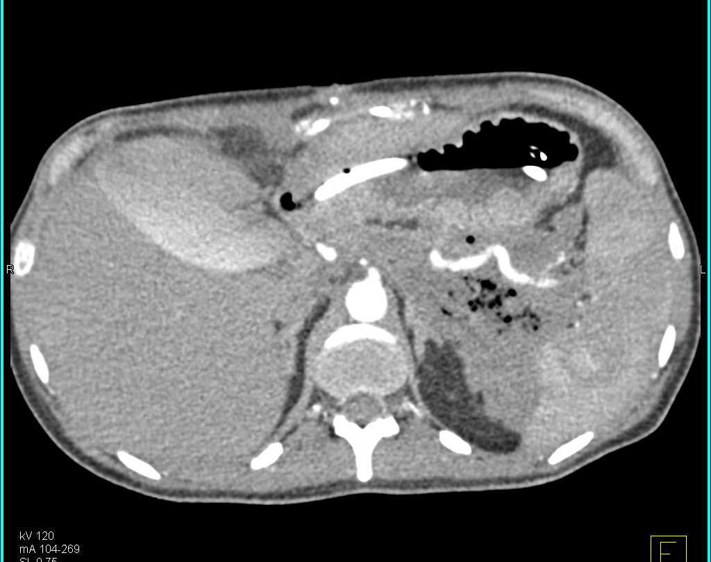 Pancreatic Necrosis - CTisus CT Scan