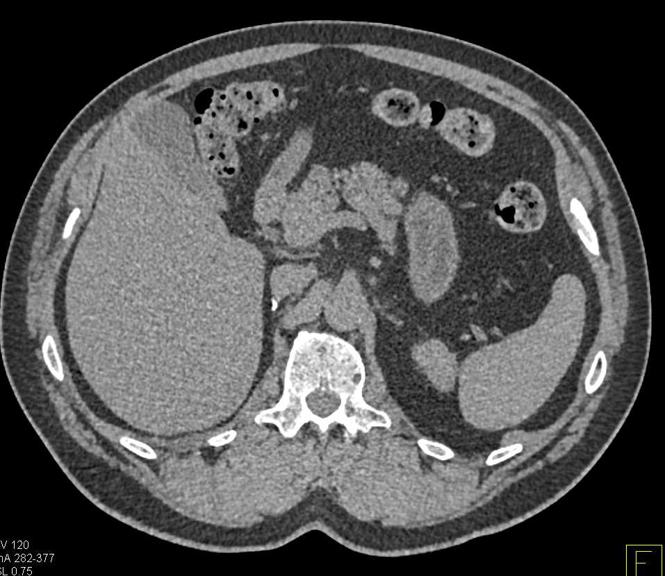 Recurrent Real Cell Carcinoma with Metastases to the Pancreas - CTisus CT Scan