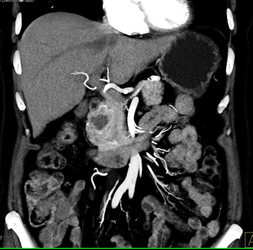 Adenocarcinoma Head of the Pancreas - CTisus CT Scan