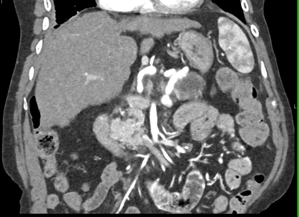 Intraductal Papillary Mucinous Neoplasm (IPMN) with High Grade Dysplasia - CTisus CT Scan