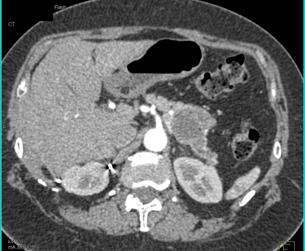 Carcinoma Tail of Pancreas with Dilated Pancreatic Duct - CTisus CT Scan