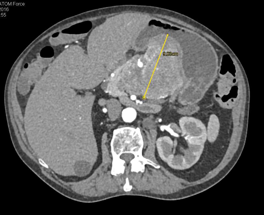 Neuroendocrine Tumor of the Pancreas - CTisus CT Scan