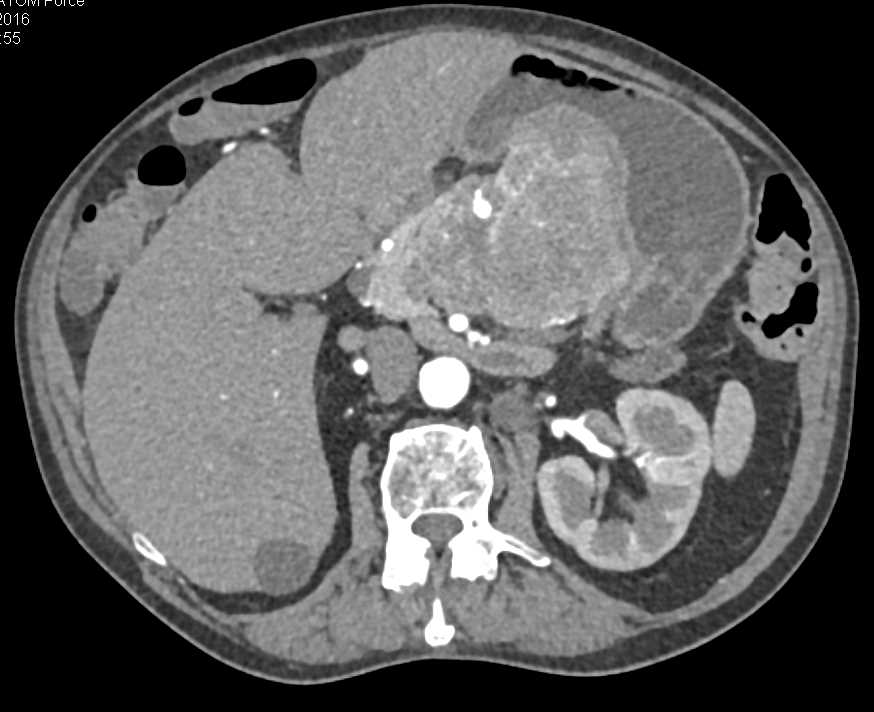 Neuroendocrine Tumor of the Pancreas - CTisus CT Scan