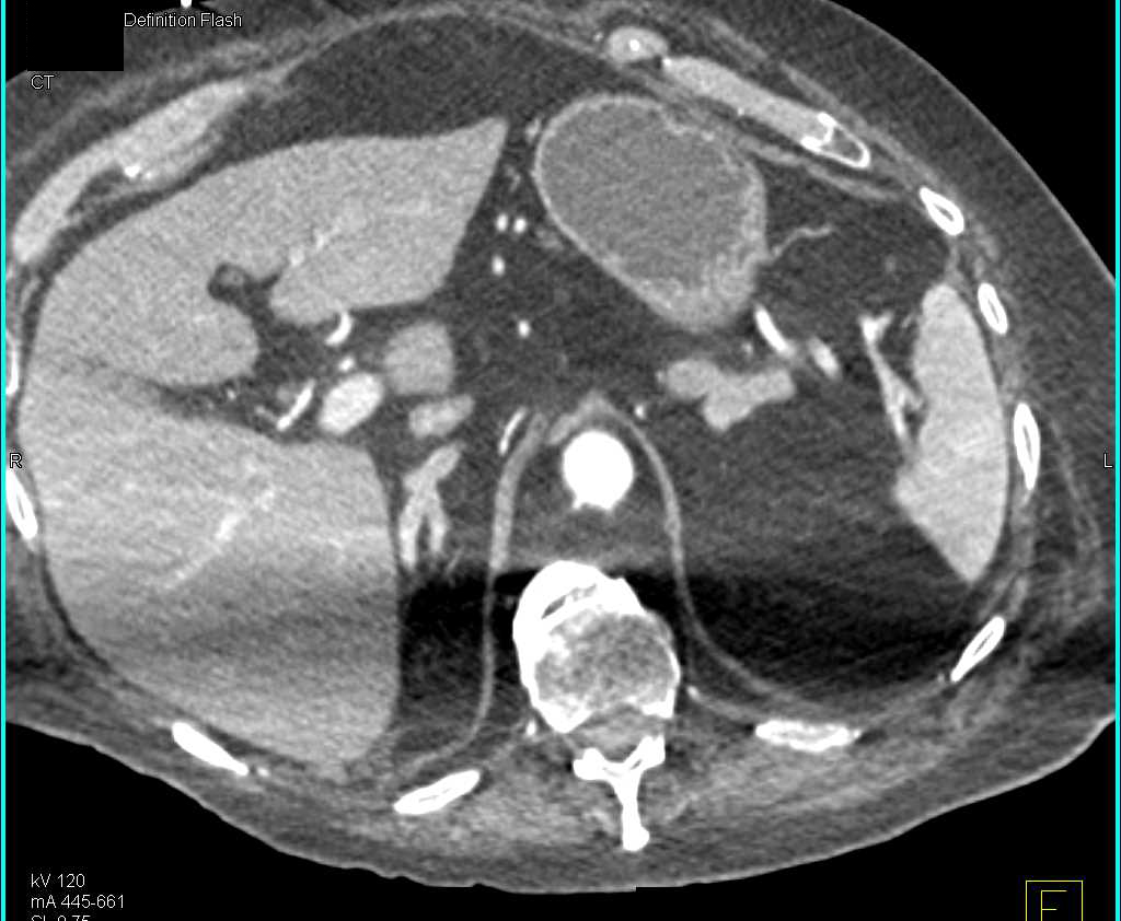 Pancreatic Neuroendocrine Tumor (PNET) in the Head of the Pancreas - CTisus CT Scan