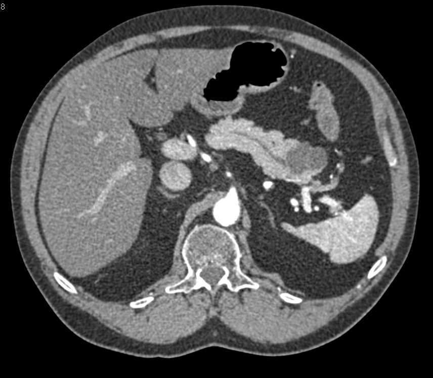 Serous Cystadenoma - CTisus CT Scan