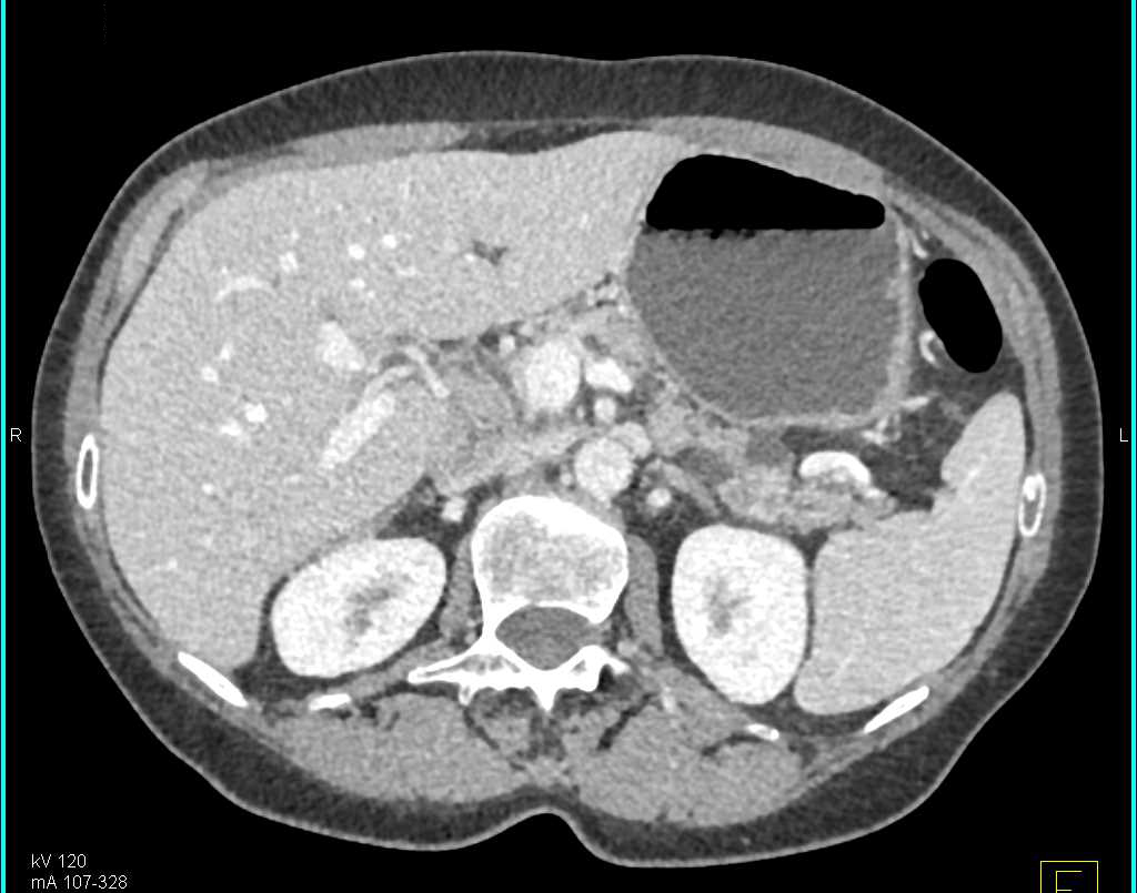 Intraductal Papillary Mucinous Neoplasm (IPMN) - CTisus CT Scan