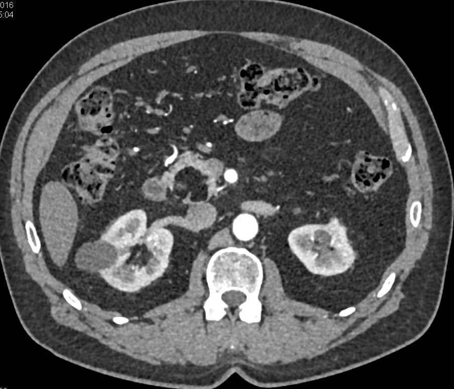 Lipoma Head of Pancreas and Intraductal Papillary Mucinous Neoplasm (IPMN) in Tail - CTisus CT Scan