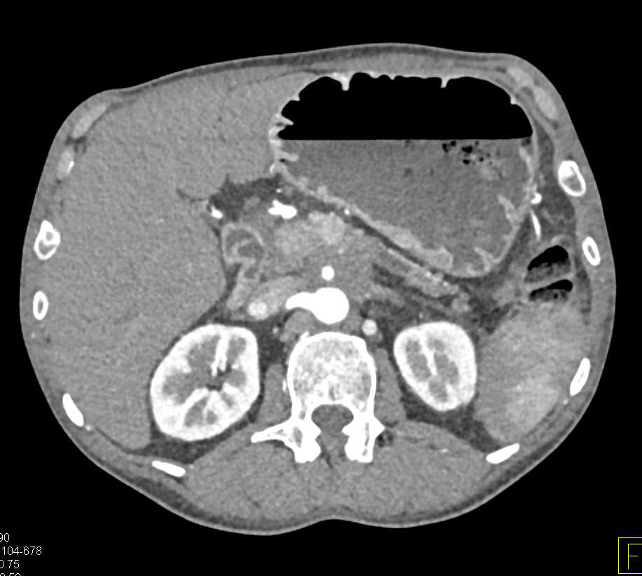 Pancreatic Adenocarcinoma Encases the Celia and Superior Mesenteric Artery (SMA) and Occludes the Splenic Vein - CTisus CT Scan