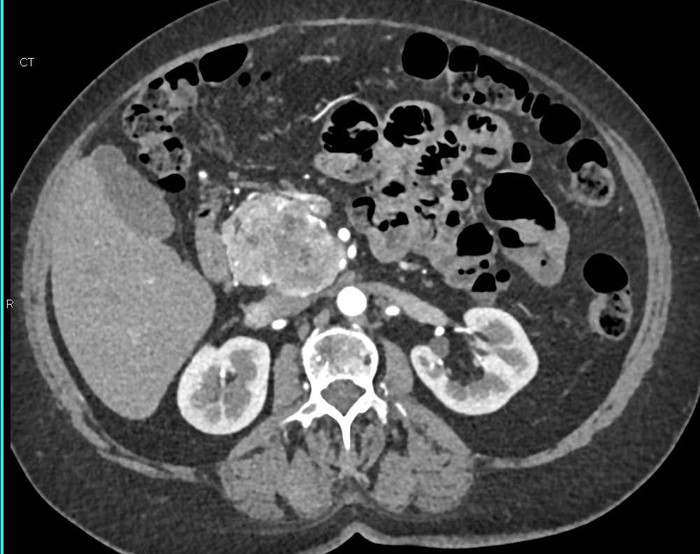 Serous Cystadenoma - CTisus CT Scan