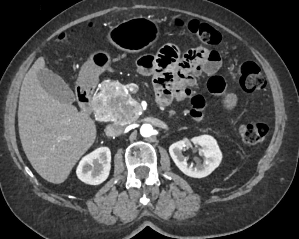 Neuroendocrine Tumor in Head of Pancreas - CTisus CT Scan