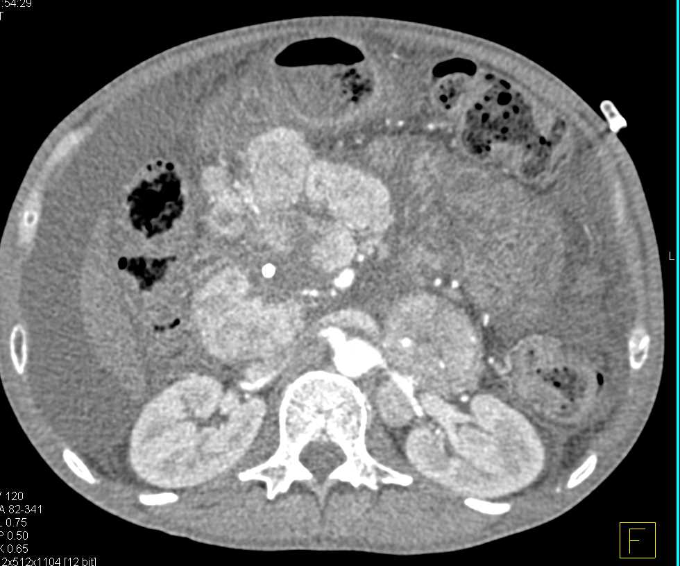 Metastatic Neuroendocrine Tumor Pancreas - CTisus CT Scan