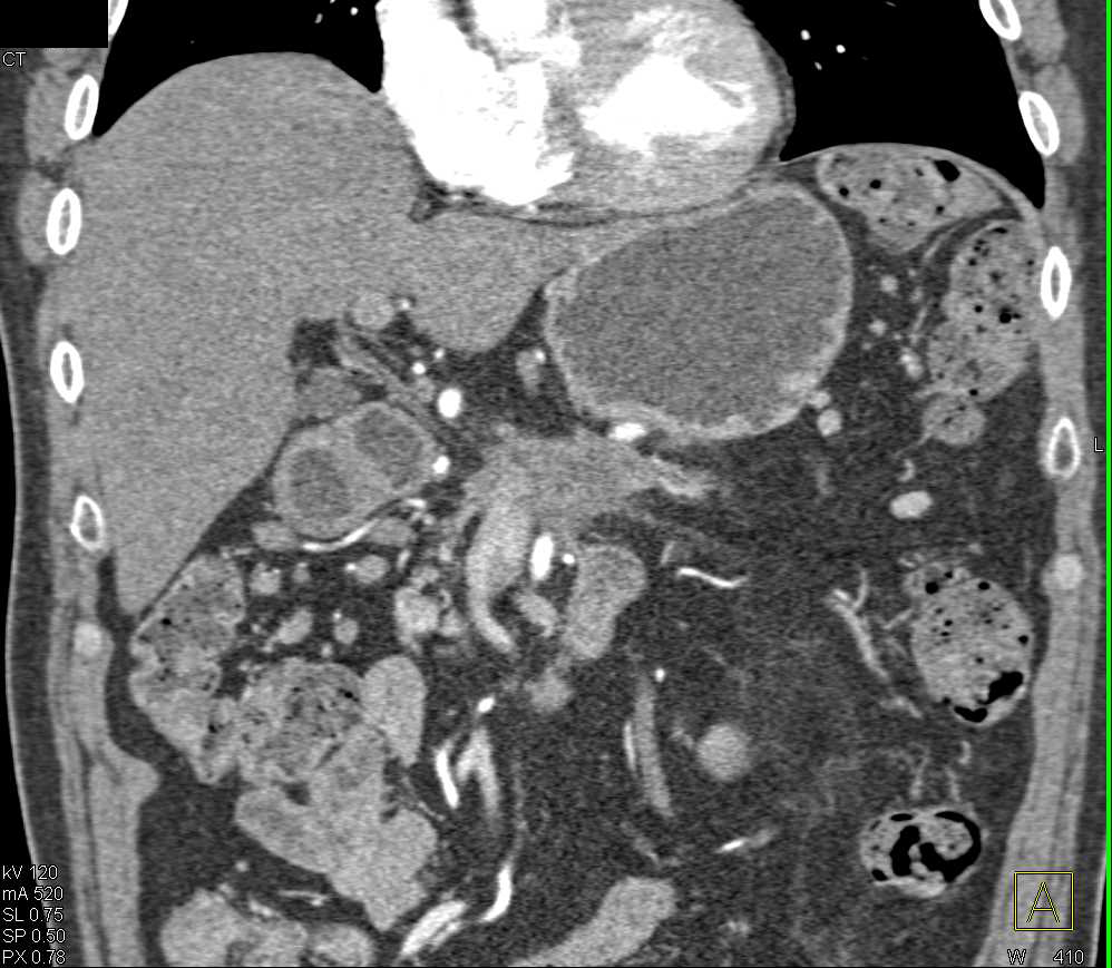 Pancreatic Adenocarcinoma - CTisus CT Scan