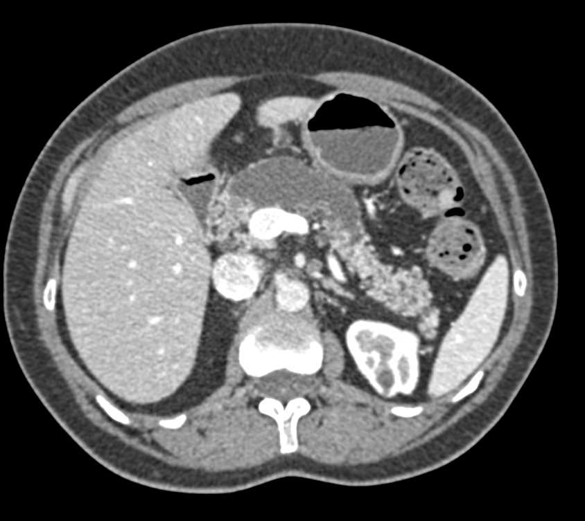 Main Duct Intraductal Papillary Mucinous Neoplasm (IPMN) with High Grade Dysplasia - CTisus CT Scan