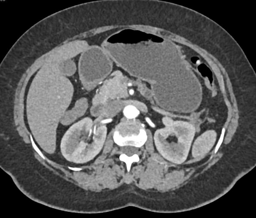 Pancreas Adenocarcinoma with Pancreatic Duct Cutoff - CTisus CT Scan