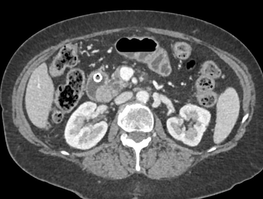 Ampullary Carcinoma - CTisus CT Scan